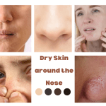 Dry skin under the nose is a common problem that affects people of all ages. It can be caused by a variety of factors, including cold weather, dry indoor air, frequent nose-blowing, and certain skin conditions. While dry skin under the nose is not usually a serious medical condition, it can be uncomfortable and unsightly. The skin under the nose is particularly susceptible to dryness because it is thinner than other areas of the face and has fewer oil glands. When the skin becomes dry, it can become itchy, flaky, and red. In severe cases, the skin may even crack and bleed. Fortunately, there are several steps you can take to prevent and treat dry skin under the nose. One of the most important things you can do is to keep the area moisturized. This can be done by applying a gentle, fragrance-free moisturizer to the skin several times a day. It is also important to avoid using harsh soaps or cleansers, as these can strip the skin of its natural oils and make the problem worse. In addition to moisturizing, you can also take steps to protect the skin from further irritation. For example, you can use a humidifier to add moisture to the air in your home, avoid touching or rubbing the area, and use a soft tissue when blowing your nose. If your dry skin under the nose is caused by a skin condition such as eczema or psoriasis, your doctor may recommend a prescription-strength medication to help manage the symptoms. In conclusion, dry skin under the nose is a common problem that can be treated and prevented with proper care. By keeping the skin moisturized and protected, you can help to alleviate the discomfort and embarrassment associated with this condition.
