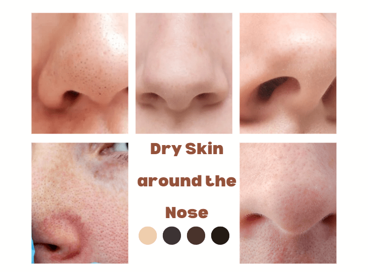 Dry Skin Under the Nose