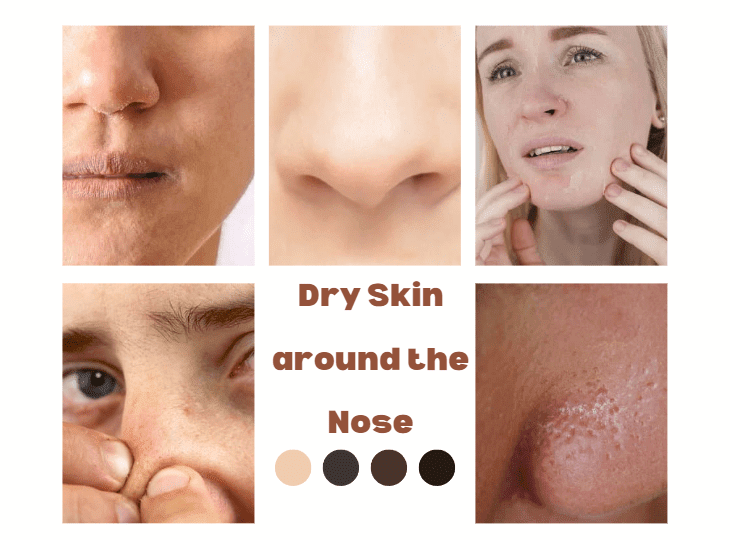 Dry Skin Under the Nose