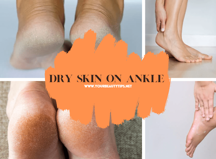How to Get Rid of Your Dry Skin on Ankle