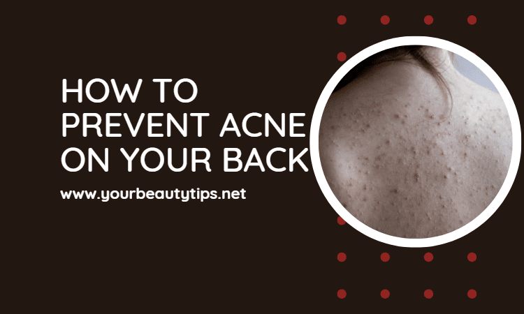 How to Prevent Acne on Your Back